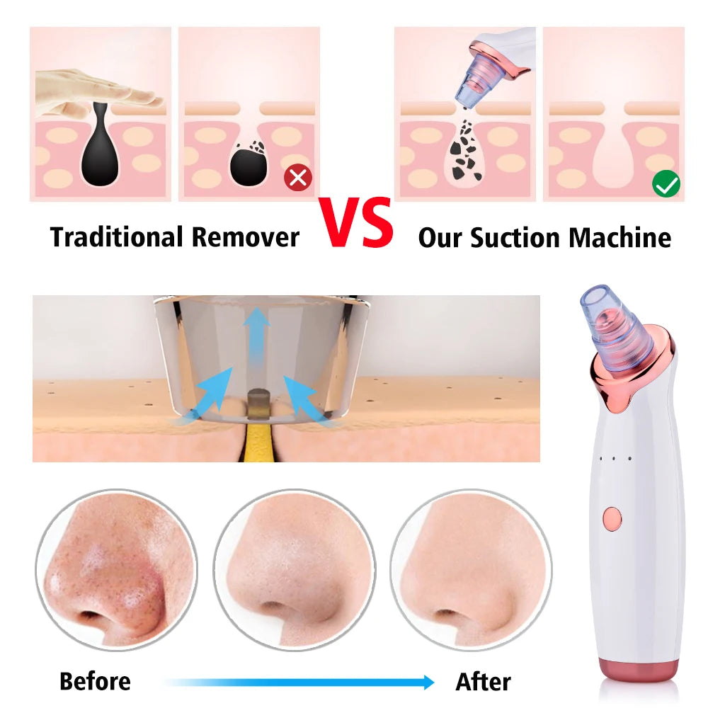 Electric Blackhead Remover & Pore Cleaner – Facial Vacuum Suction Tool for Blackheads, Acne & Pore Care, Portable Skin Cleaning Device