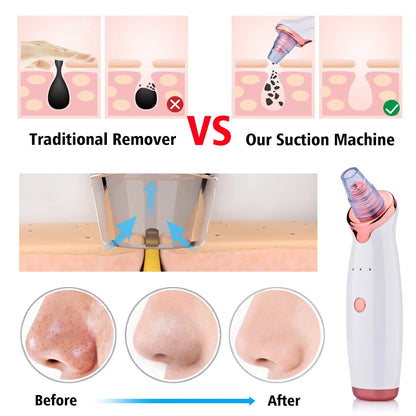 Electric Blackhead Remover & Pore Cleaner – Facial Vacuum Suction Tool for Blackheads, Acne & Pore Care, Portable Skin Cleaning Device